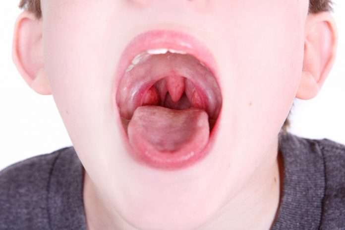how to treat children in tonsils